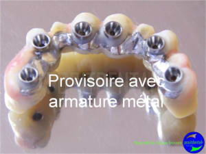 Cicatrisation gingivale suite eimci positdental 3 fiazof - Eugenol