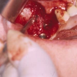 Comblement pgddvx - Eugenol