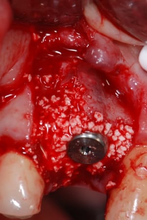 Comblement ueqajm - Eugenol