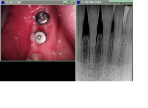 Complication s2j3qo - Eugenol