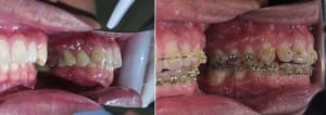 Cross bite3 yeiqh6 - Eugenol