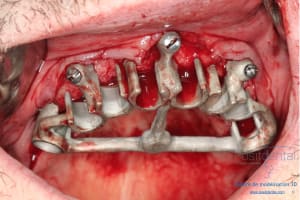 Déoulé d une mci dr r - Eugenol