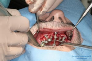 Déoulé d une mci dr r - Eugenol