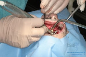 Déoulé d une mci dr r - Eugenol