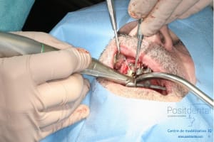 Déoulé d une mci dr r - Eugenol