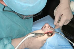 Déoulé d une mci dr r - Eugenol