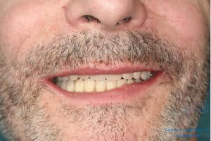 Déoulé d une mci dr r - Eugenol