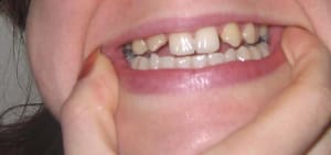 Dents  close up vrbufw - Eugenol
