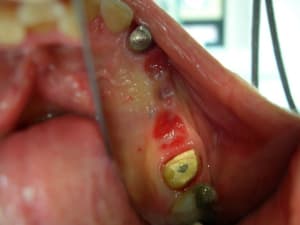 Dents1 015 lqcfqf - Eugenol