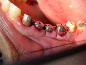 Dents1 019 gysw4t - Eugenol