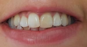 Dyschromie 21 sourire cupslo - Eugenol