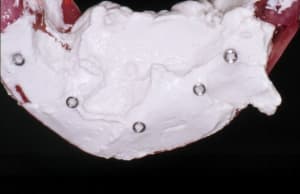 Empreinte plâtre cuefdu - Eugenol