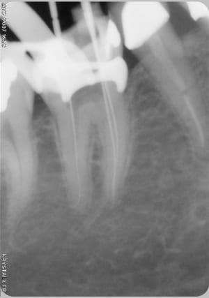 Endo1 zab5wn - Eugenol