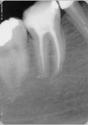 Endo2 jjqbcd - Eugenol