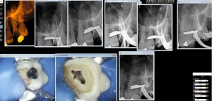 Endo 27 q3klnm - Eugenol