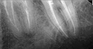 Endo 31  2  cones tife1i - Eugenol