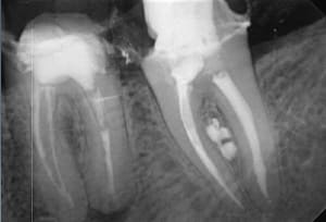 Endo 31  3  postop maybe crack or fracture e9js3k - Eugenol