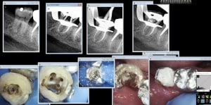 Endo 47 f6yirr - Eugenol
