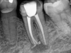 Endo x 3 postop h4oh16 - Eugenol