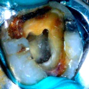 Endodecematin f2wxoo - Eugenol