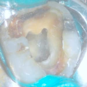 Endodecematin symyl2 - Eugenol