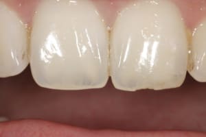 Essai photo dentaire 011 cj8hcs - Eugenol