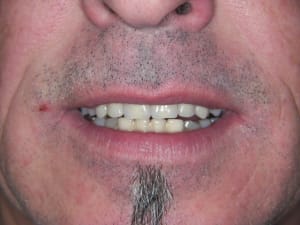 Essayage sourire rlc2su - Eugenol
