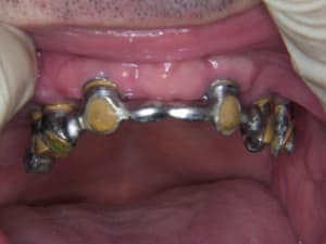 Fixation pilier 25ncm et collage galvanos en bouche htxov6 - Eugenol