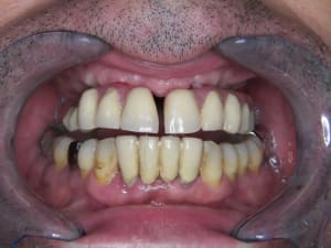 Fracture app resine 3mois post mci avec coiffes telescopes rpefabriqu s wets2a - Eugenol