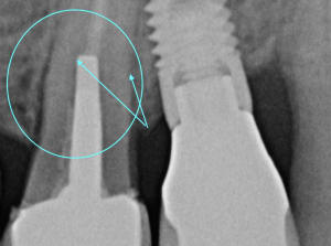 Fracture c4ivzf - Eugenol
