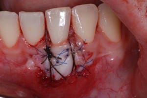 Greffe bcun9k - Eugenol