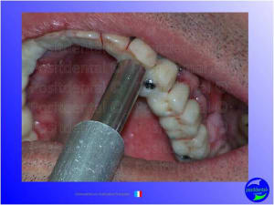 Guide chirurgical   mise en charge imm diate 018 qn58zr - Eugenol