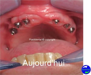 Guide chirurgical  mise en charge imm diate en 1 seul temps 007 rereaq - Eugenol
