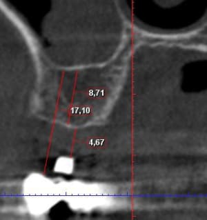 Implant 17 gkmdvi - Eugenol