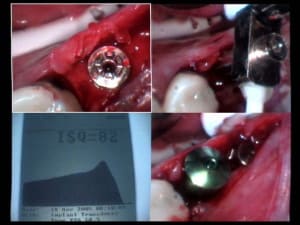 Implant 45 isq lelbpc - Eugenol