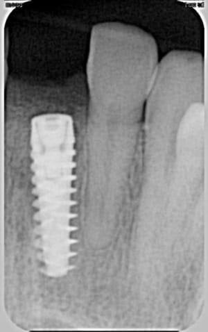 Implant en place k9cfmx - Eugenol