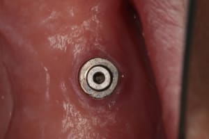 Implant inconu 002 tb6gzz - Eugenol