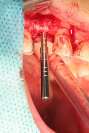 Implantation1 l2vnju - Eugenol