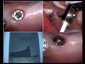 Implants aurélia 02 04 2005 position 45 woah woah cz4jhp - Eugenol