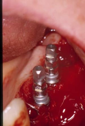 Implants cj4ewk - Eugenol