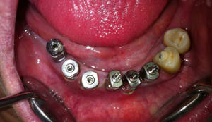 Implants rhzmyj - Eugenol