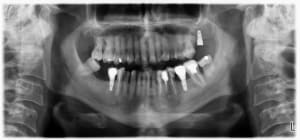 Implants tekka snj6ln - Eugenol