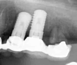 Implantsiamois tioeut - Eugenol