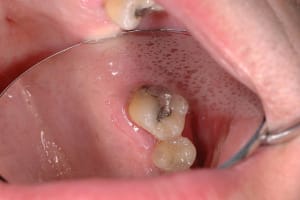 Initial ttirce - Eugenol