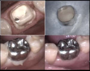 Inlay core    2 xyixg1 - Eugenol