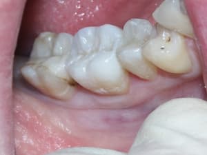 Inlaycompo x46jlu - Eugenol