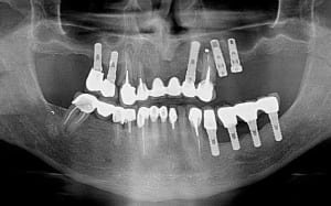 Kyste implant sy8hia - Eugenol