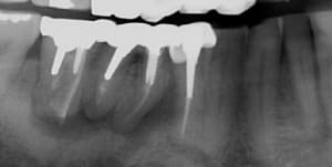 Lésion ml9obs - Eugenol