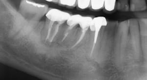 Lésion q42kwb - Eugenol