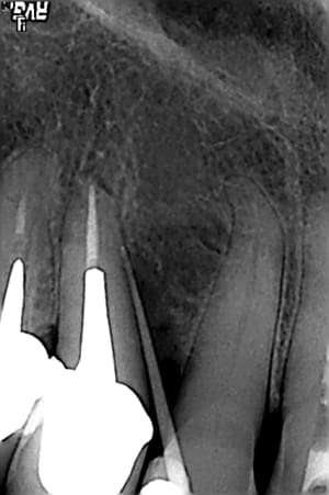 Le tal1 ircoiu - Eugenol